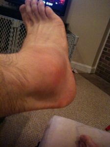 My ankle What the ankle looks like today.